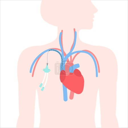 Illustration for Tunneled central venous catheter placed in the subclavian vein. Patient with CVC long term access device for chemotherapy infusions and blood sampling. Central line tube close up. Vector illustration. - Royalty Free Image