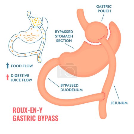 Illustration for Roux-en-y gastric bypass. Bariatric surgery weight loss procedure. Stomach reduction anatomical diagram infographic. Health care medical concept. Vector illustration. - Royalty Free Image