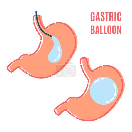 Illustration for Gastric balloon non surgical weight loss procedure in stomach. Medical concept. Human body organ anatomy and health care. Vector illustration in flat style. - Royalty Free Image
