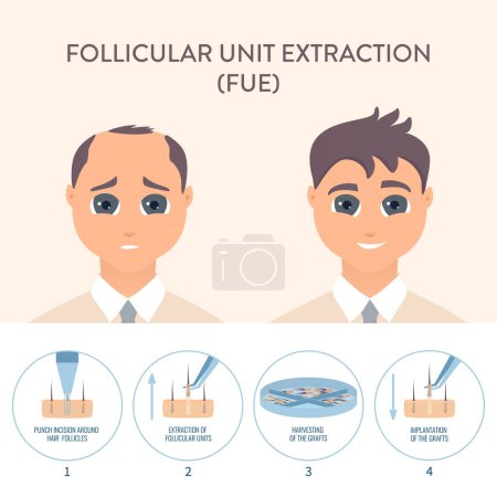 Illustration for Hair transplant alopecia treatment by FUE. Stages of follicular unit extraction restoration surgery for men. Health care and medical concept. Vector illustration. - Royalty Free Image