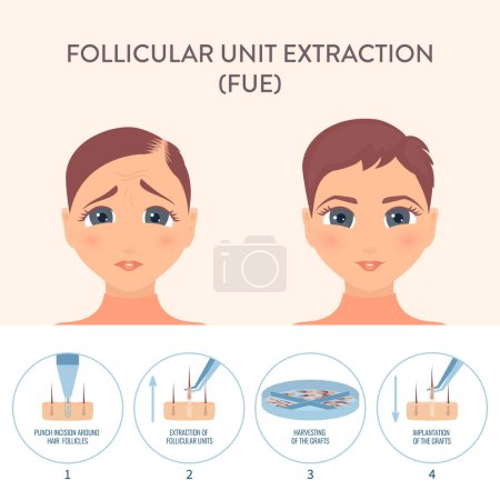 Illustration for Hair transplant alopecia treatment by FUE. Stages of follicular unit extraction restoration surgery for women. Health care and medical concept. Vector illustration. - Royalty Free Image
