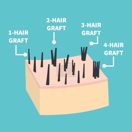 Illustration for Hair micrograft classification set for hair transplantation surgery. Skin cross-section with number of hairs in the follicular unit or family. Hair science and anatomy. Cartoon vector illustration. - Royalty Free Image