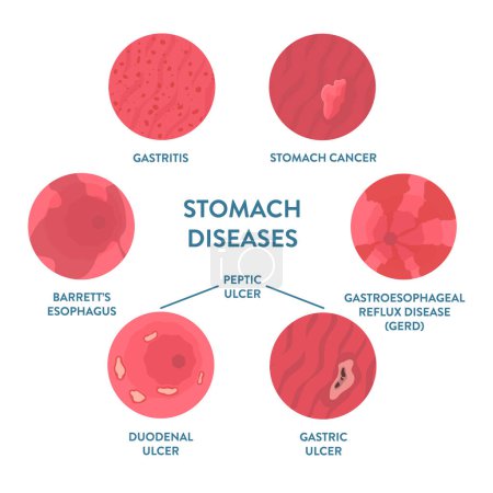 Illustration for Types of stomach diseases detected by endoscopy diagnostics - gastritis, peptic ulcer, GERD, cancer, Barrett esophagus. Gastrointestinal tract disorder. Medical concept. Vector illustration. - Royalty Free Image