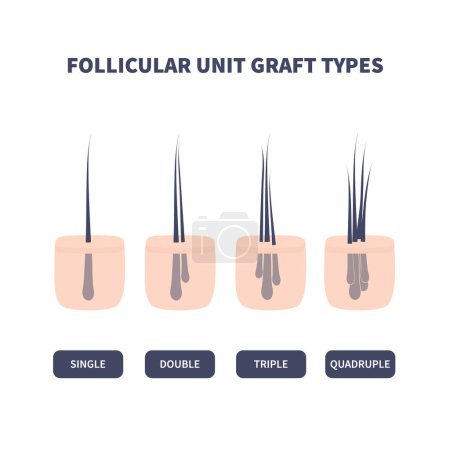Hair micrograft classification set for hair transplantation surgery. Skin cross-section with number of hairs in the follicular unit or family. Hair science and anatomy. Cartoon vector illustration.