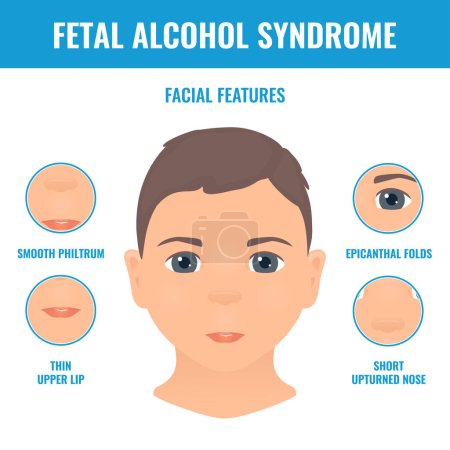 Facial features in a child with fetal alcohol syndrome. Foetal alcohol spectrum disorder signs. FASDs symptoms diagram. Medical concept. Vector illustration.