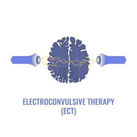 Illustration for Electroconvulsive therapy for severe depression and schizophrenia treatment. ECT electrodes placement. Brain stimulation equipment for bipolar and major depressive disorders. Vector illustration. - Royalty Free Image