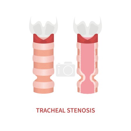 Illustration for Tracheal stenosis awareness illustration. Trachea narrowing symbol. Difficulty breathing, hoarseness and voice change symptoms. Healthcare concept. Isolated flat vector illustration. - Royalty Free Image