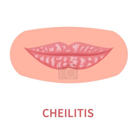 Illustration for Cheilitis oral disease icon. Lips inflamation and irritation with cracking and peeling skin. Dermatitis outbreak. Medical concept. Vector illustration isolated on white. - Royalty Free Image