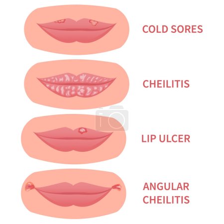 Illustration for Mouth disease medical set. Cold sores and angular cheilitis with cracked corners. Lips ulcer inflamation with cracking and peeling skin. Dermatitis outbreak. Medical concept. Vector illustration. - Royalty Free Image