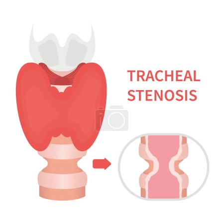 Illustration for Tracheal stenosis awareness illustration. Trachea narrowing symbol. Difficulty breathing, hoarseness and voice change symptoms. Healthcare concept. Isolated flat vector illustration. - Royalty Free Image