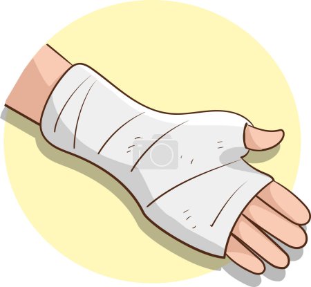 vector illustration of broken hand with plaster  