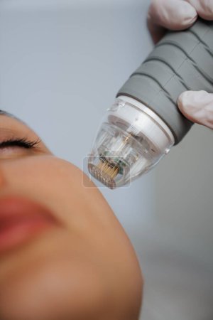 Photo for Microneedle RF lifting in a beauty salon. Big plan. High quality photo - Royalty Free Image