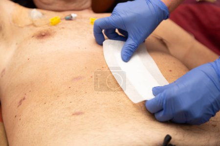 Téléchargez les photos : Mains d'un agent de santé portant une blessure infectée sur l'abdomen d'un homme avec un port veineux - en image libre de droit