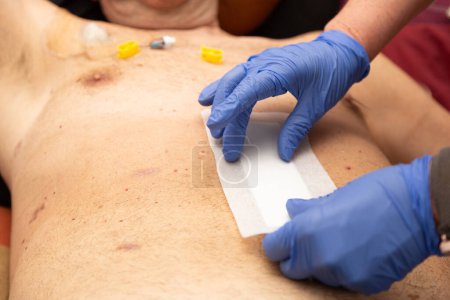 Téléchargez les photos : Mains d'un agent de santé portant une blessure infectée sur l'abdomen d'un homme avec un port veineux - en image libre de droit