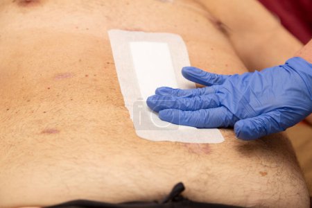 Hände eines Gesundheitshelfers, die eine infizierte Wunde am Bauch eines Mannes mit einem Venenanschluss anlegen