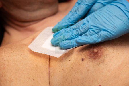 Hände eines Gesundheitshelfers, die eine infizierte Wunde am Bauch eines Mannes mit einem Venenanschluss anlegen