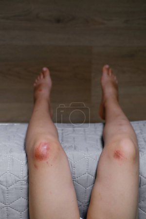 Foto de Lesión infantil. Rasguños profundos en la piel de la rodilla de los niños. Heridas, arañazos, abrasiones en la pierna del niño. Botella de antiséptico y esponjas para limpiar la herida - Imagen libre de derechos
