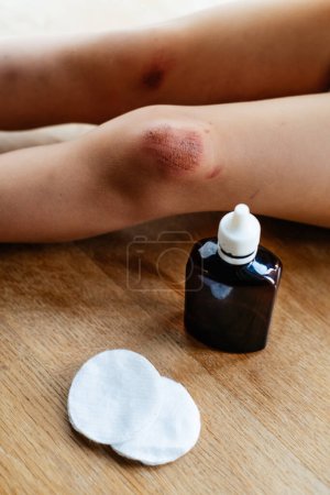 Photo for Children injury. Deep scratches on the skin on the kids knee. Wounds, scratches, abrasions on the child leg. Bottle of antiseptic and sponges to clean the wound - Royalty Free Image