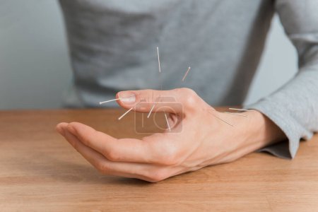 Téléchargez les photos : Homme utilisant un traitement d'acupuncture pour soulager la douleur. Médecine alternative chinoise - en image libre de droit