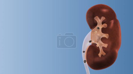 Photo for Kidney stones treatment medical concept 3d illustration - Royalty Free Image