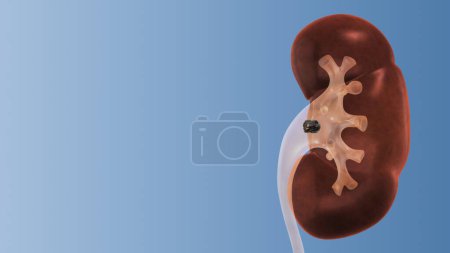 Human Kidney stones medical concept