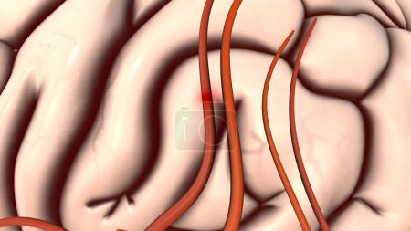 Photo for Atherosclerotic cardiovascular disease and stroke - Royalty Free Image