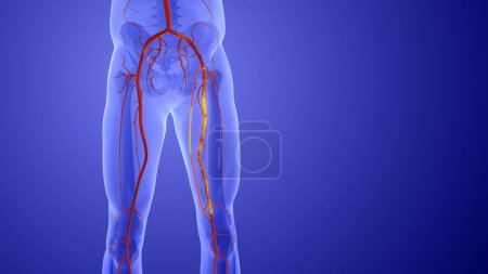 Photo for Animation of peripheral artery bypass surgery - Royalty Free Image