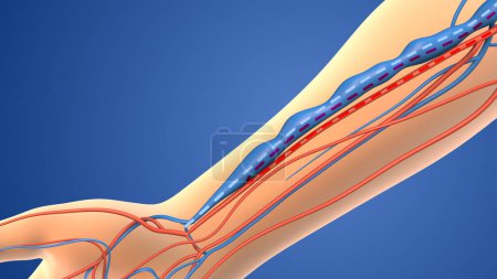 Foto de Animación médica de la fístula arteriovenosa - Imagen libre de derechos