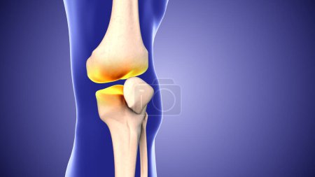 Knieschmerzen und die Lücke in den Kniegelenken
