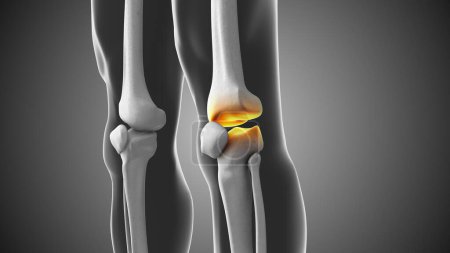 Téléchargez les photos : Douleurs articulaires au genou avec une animation médicale lacune - en image libre de droit