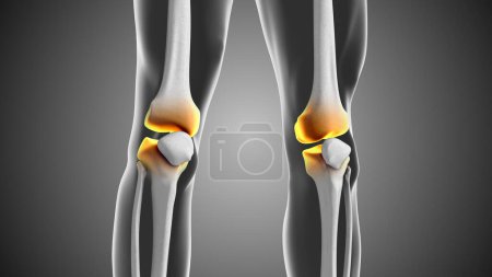 Lücke zwischen Kniegelenken und Kniebeschwerden