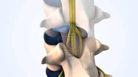 Lumbar spine herniated disc medical animation