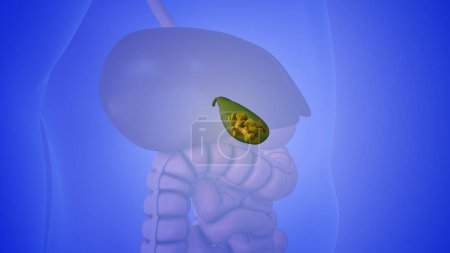 Gallstones in the gallbladder medical animation