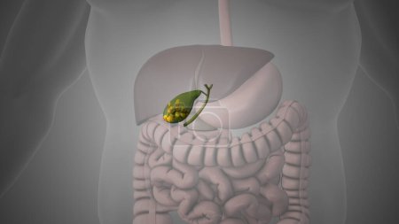 Animación médica que muestra cálculos biliares en la vesícula biliar