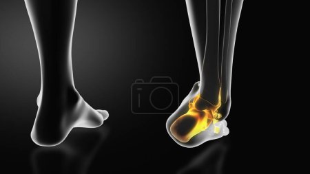 Photo for Ankle injury with dislocation and sprains - Royalty Free Image