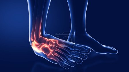 sprains and dislocations to the ankle