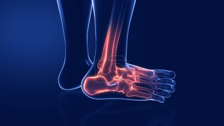 Photo for Sprains and dislocations to the ankle - Royalty Free Image