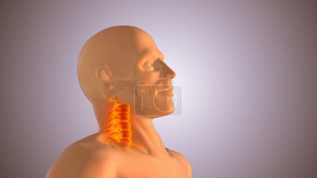 Téléchargez les photos : Lésions du cou ou de la colonne cervicale - en image libre de droit