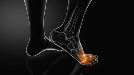 Metatarsalgie oder Fußschmerz