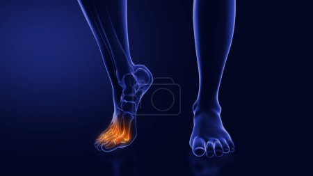 Foto de Bola de dolor en el pie o Metatarsalgia - Imagen libre de derechos