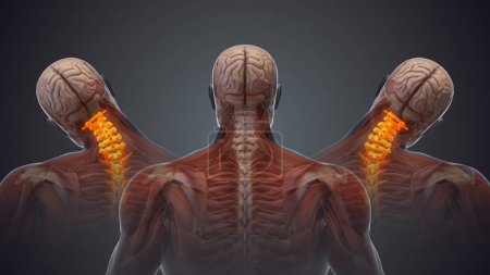 Photo for Medical animation for neck pain - Royalty Free Image