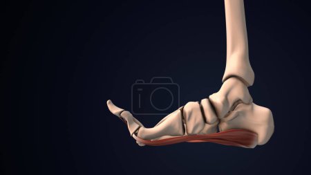 Photo for Dysfunction of the plantar fascia - Royalty Free Image