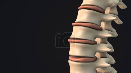 Foto de Disco protuberante en la columna vertebral humana - Imagen libre de derechos