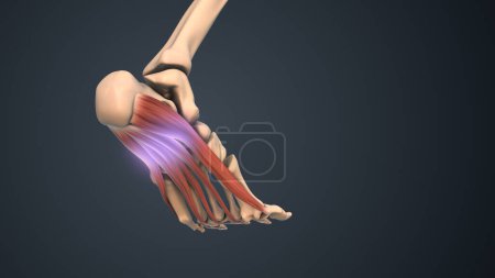 Photo for Plantar fascia dysfunction medical concept - Royalty Free Image