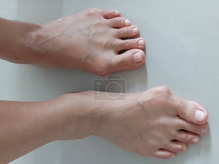 Woman feet with hallux valgus, Bunion, Bony Bump.  