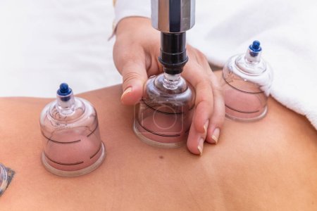 Photo for Woman lying on her chest with cupping treatment on her back. woman doing sucker - Royalty Free Image
