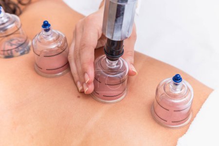 Photo for Woman lying on her chest with cupping treatment on her back. woman doing sucker - Royalty Free Image
