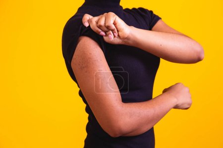 Téléchargez les photos : Gros plan sur le bras d'une femme afro allergique. - en image libre de droit