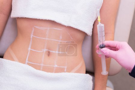 Photo for Close-up photo of a woman's belly, photo of aesthetics, procedures on the abdomen. beauty clinic. ozone application, ozone therapy, enzymes, slimming. weight loss. - Royalty Free Image