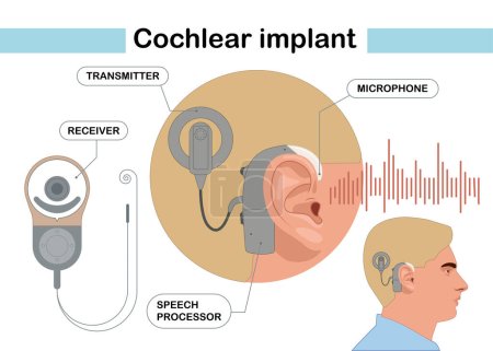 El dispositivo de implante coclear estimula eléctricamente la ayuda médica del nervio oído ondas sonoras adultos examen medio duro. Ilustración vectorial moderna en estilo plano